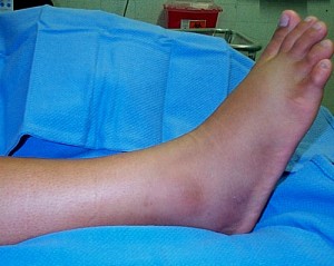 ankle fractures